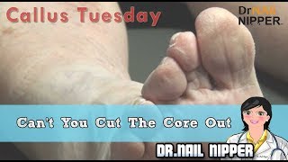 What does Foot Corn look like Callus Cant You Cut The Core Out Callus Tuesday 29 [upl. by Urita390]