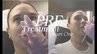 PRF Under Eye Treatment  Pt 1 [upl. by Donnelly]