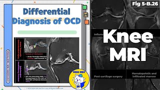 Fig 5B26 Differential Diagnosis of Osteochondritis Dissecans [upl. by Stone]