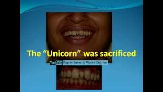 Extra tooth between front teeth  Fixed braces amp no teeth removed [upl. by Yesak]