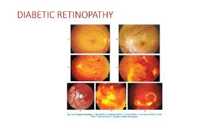 Ophthalmology Diabetic reinopathy  hypertensive retinopathy [upl. by Nadroj231]