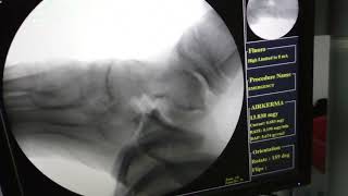 CALCANEONAVICULAR COALIATION EXCISION [upl. by Moffitt]