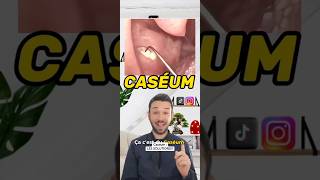 Qu’est ce que le Caséum  tonsil tonsilstones tonsilitis caseum breath breathing santé [upl. by Diad413]