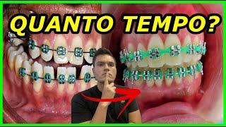 QUANTO TEMPO O ELÁSTICO EM CORRENTE LEVA PARA FECHAR ESPAÇOS DE DENTES SEPARADOS [upl. by Ataynik]