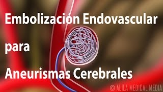 Embolización Endovascular para Aneurismas Cerebrales Alila Medical Media Español [upl. by Ellicott]