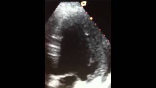 Paradoxical septal motionultrasoundlifecom [upl. by Redep477]