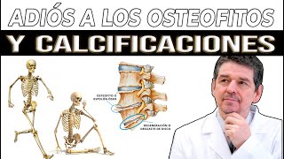 Cómo ELIMINAR los OSTEOFITOS para siempre Di adiós a las calcificaciones y quistes de Calcio [upl. by Lipscomb231]