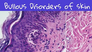 Bullous Disorders of Skin dermatology dermatopathology [upl. by Ylen371]