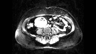 Retroperitoneal paraganglioma [upl. by Taryne]