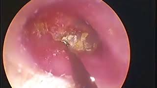 Earwax Removal Extractions Combo 5 耳屎处理小合集5 外耳道挖耳屎清理 耳垢 耳垢 [upl. by Cordelie]