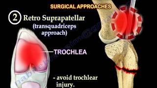 Intramedullary Nailing Proximal Tibial Fractures  Everything You Need To Know  Dr Nabil Ebraheim [upl. by Viola]