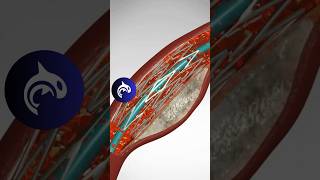 See how an Angioplasty and Stent Placement work in 3D animation [upl. by Ajat]