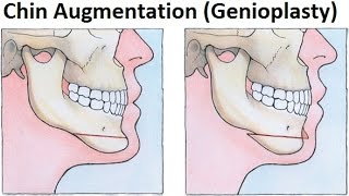 Treatment of Retruded JawsMandible Using GenioplastyMentoplastyChin Augmentation by Dr Mike Mew [upl. by Akiria327]