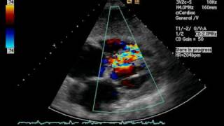 Septal Pseudoaneurysm Post MI [upl. by Reizarf]