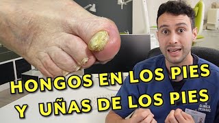 🦶 HONGOS en los PIES y UÑAS de los pies  Onicomicosis síntomas tratamiento prevención y dudas [upl. by Jaal]