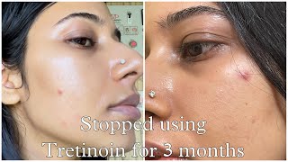 I stopped using Tretinoin for 3 months amp This happened [upl. by Spratt]