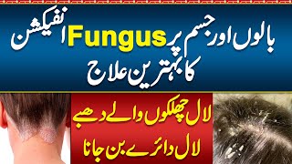 Fungus on Skin Treatment  Fungus in Hair Scalp treatment  Fungus Ka ilaj  Fungus Infection [upl. by Oirottiv]