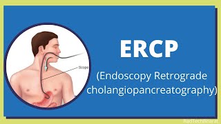 Endoscopic retrograde cholangiopancreatography ERCP [upl. by Eatnad]