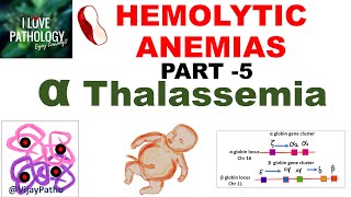 Hemolytic Anemias Part 5 Alpha Thalassemia Pathogenesis types Diagnosis amp Treatment [upl. by Cristian]