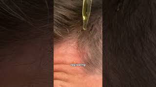 Do derma rollers help regrow hair hairloss hairlosstreatment hairgrowth dermaroller [upl. by Millicent821]