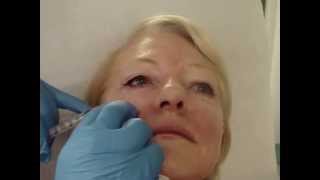 Injecting Platelet Rich Plasma around the eye [upl. by Tawnya]