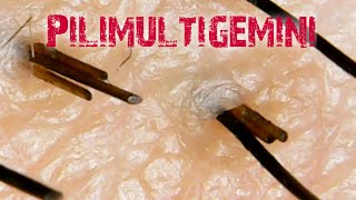 PilimultigeminiHair Extractionmultiple hairs [upl. by Eelsnia]