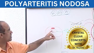 Polyarteritis Nodosa Clinical Features  Complications  Management [upl. by Hamer]