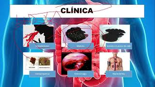 HEMORRAGIA DIGESTIVA ALTA  Definición Etiología diagnóstico  Forrest Tratamiento [upl. by Ahsial]