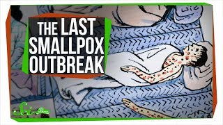 The Last Major Smallpox Outbreak in America [upl. by Chernow850]