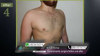 Gynecomastia Surgery Before and After in Turkey  2024 [upl. by Yasdnyl]