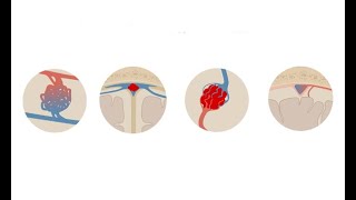 Recognizing subarachnoid hemorrhage on computed tomography CT [upl. by Serra]