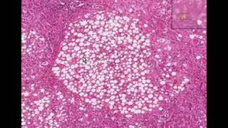 Histopathology LiverAlcoholic liver disease [upl. by Ehav]