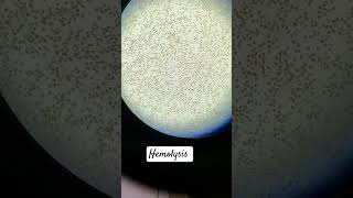 Hemolysis in RBC [upl. by Cassil603]