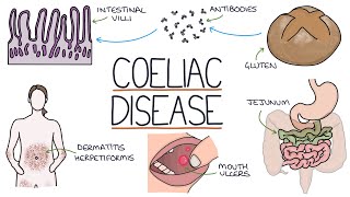 Understanding Coeliac Disease [upl. by Rafaelle]