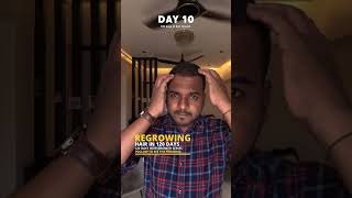 Using Derma roller and Minoxidil for Hair growth  Day 10 minoxidil dermaroller hairloss hair [upl. by Luedtke39]