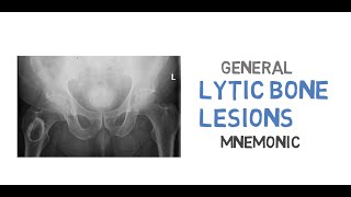 What are the differentials for lytic bone lesions [upl. by Oneal]