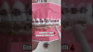 Gingivitis Tooth Bleeding You Need This Water Flosser [upl. by Latashia]