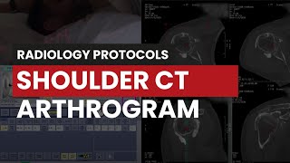 Shoulder CT Arthrogram Protocol Guide for Radiology Techs [upl. by Ahsiet]