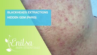 Blackheads Extraction Hidden Gem Paris [upl. by Smoot]