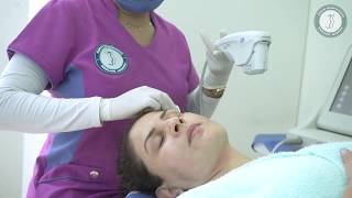 El mejor lifting facial sin cirugía Ultherapy [upl. by Heller]