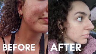 DID DOXYCYCLINE WORK  My Doxycycline Experience Doxycycline for Acne Before and After Pictures [upl. by Chiquita]