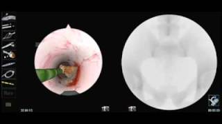 Kidney Stone Removal on Simbionix URO Mentor [upl. by Dnivra]