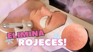 ELIMINA ROJECES FÁCIL 😱 Facial para piel sensible ❄ [upl. by Nosyarg]