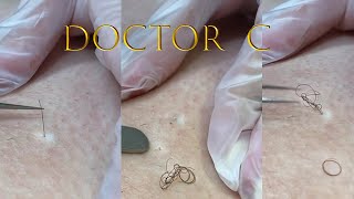 cleaning infected ingrown hair [upl. by Rases708]