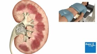 How extracorporeal shockwave lithotripsy is used to treat kidney stones  Bupa Health [upl. by Neeloj400]