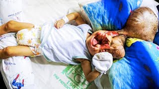 Baby Born Without a Face Survives and Did the Unthinkable [upl. by Anitsyrc]