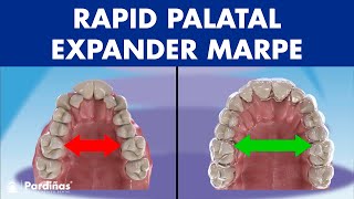 Rapid PALATAL expander MARPE  This ORTHODONTIC device can EXPAND the PALATE in adults© [upl. by Yltsew]