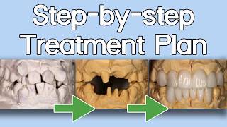 Stepbystep Treatment Plan  Minimum Prep Guide  Dental Lab Learning [upl. by Nazar]