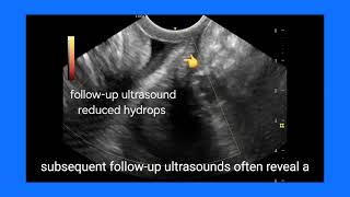 Understanding Cervical Hydrops Ultrasound Findings FollowUp Causes and Treatment Explained [upl. by Daffi819]