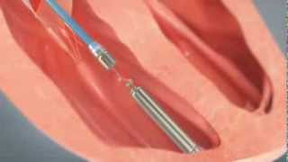 How to Insert a Tiny Wireless Pacemaker Into a Human Heart [upl. by Anaihr]